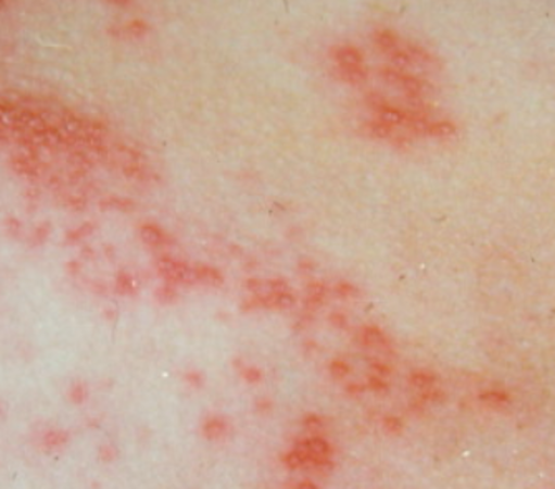 帶狀皰疹 (Shingles)